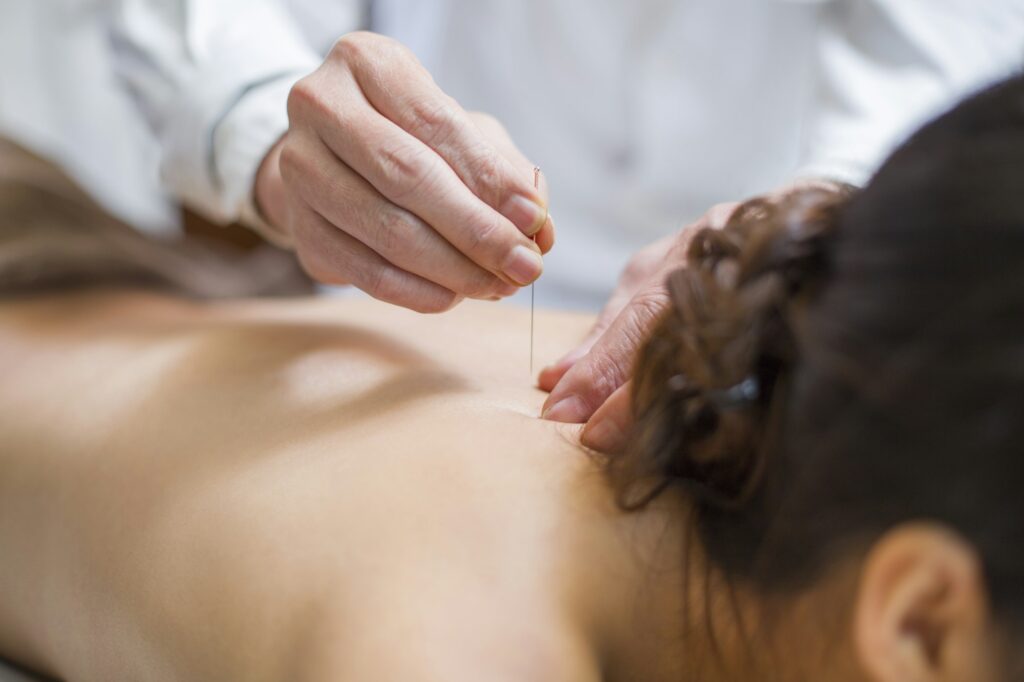 Holistic Approaches To Relieving Stress 6 Young woman receiving acupuncture